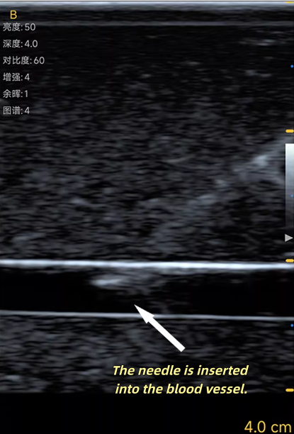 Ultrasound Vascular Puncture T - Medical Gel Ultrasound review and price
